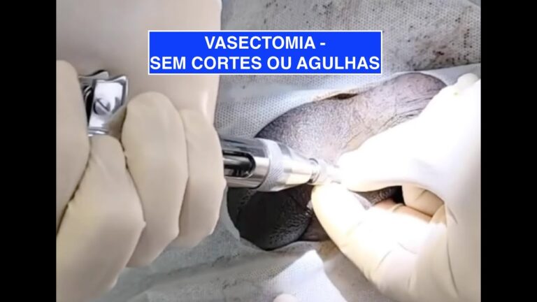 Vasectomia: Anestesia Local ou Geral?