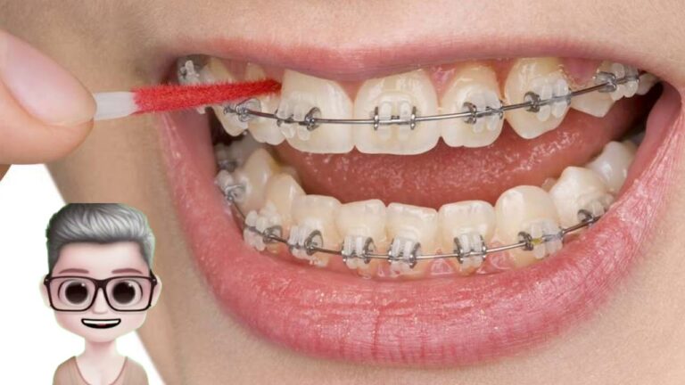 Significado de Sonhar com Aparelho nos Dentes