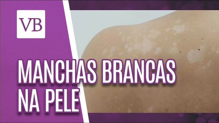 Causas e Tratamentos para Mancha Branca embaixo dos Olhos