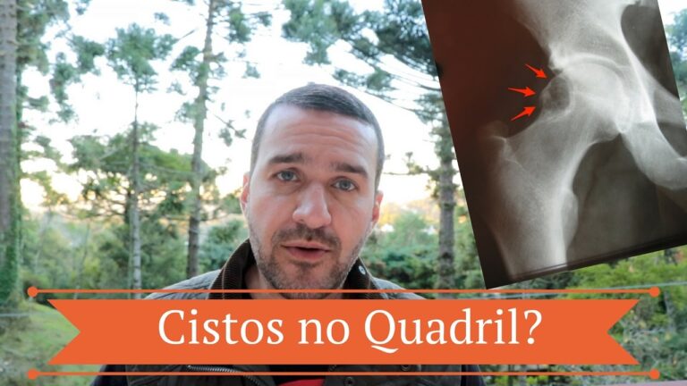 Como Tratar o Cisto Condral Eficazmente