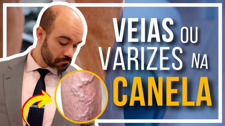 Veias Saltadas na Perna: Causas e Tratamentos