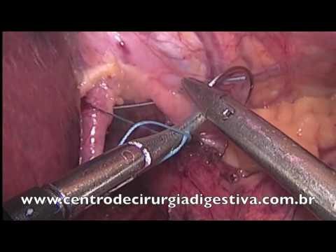 Cicatriza&ccedil;&atilde;o Eficiente Ap&oacute;s Cirurgia de H&eacute;rnia de Hiato