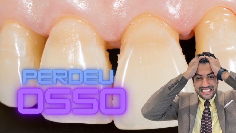 Impacto do Tártaro na Perda Óssea