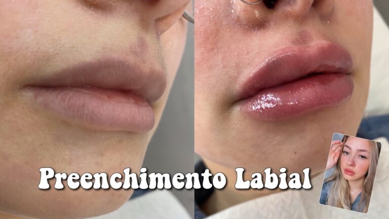 Tempo de Desinchaço do Preenchimento Labial