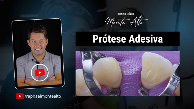 Guia Completo sobre Prótese Adesiva para Dentes