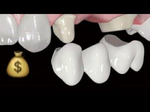 O Custo da Ponte Dentária: O Que Você Precisa Saber