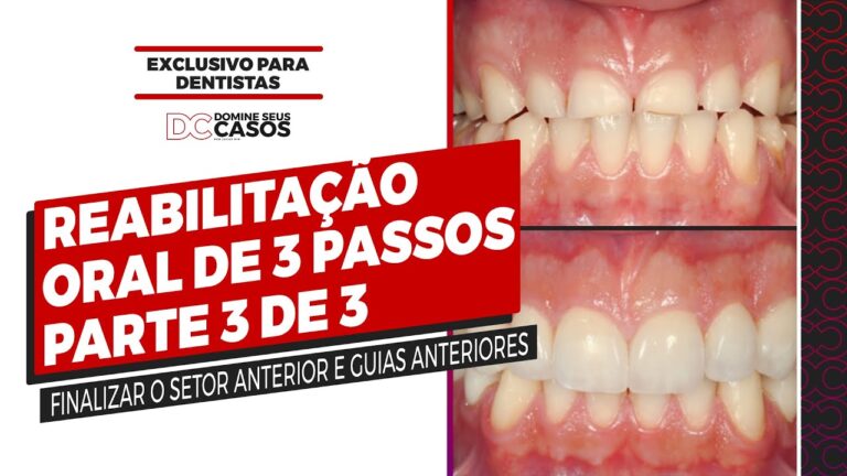 Restauração Eficaz para Dentes Desgastados pelo Bruxismo