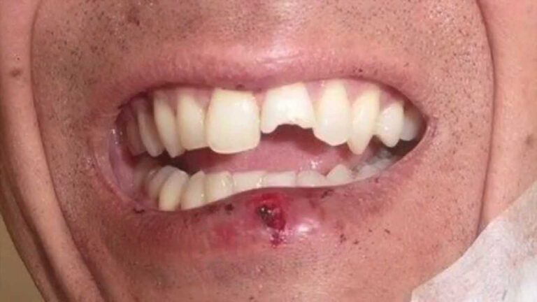 Restauração Eficiente de Dente Quebrado com Resina