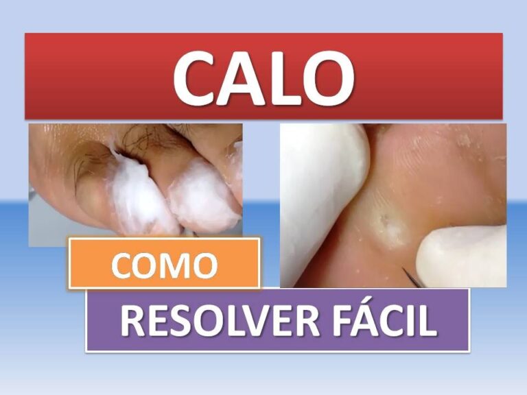 Como a Podologia Remove Calos de Forma Eficiente