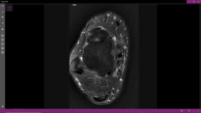 Entendendo o Osso Navicular Inchado: Causas e Tratamentos