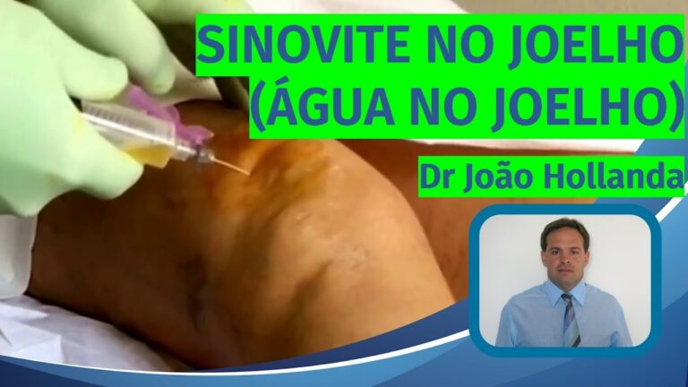 Tratamento Eficaz para Sinovite: Opções e Abordagens
