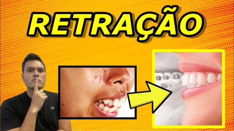 Aparelho Inovador para Puxar Dentes para Tr&aacute;s