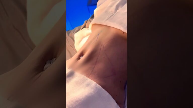 Transformações de Abdominoplastia e Lipoescultura: Antes e Depois