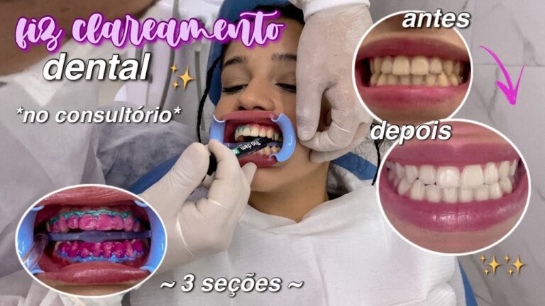 Transformações do Clareamento Dentário: Antes e Depois