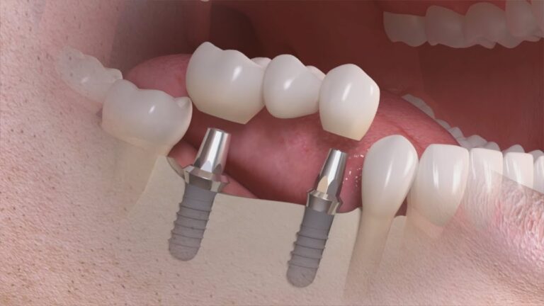 Preço do Implante de Dois Dentes Juntos: O Que Saber