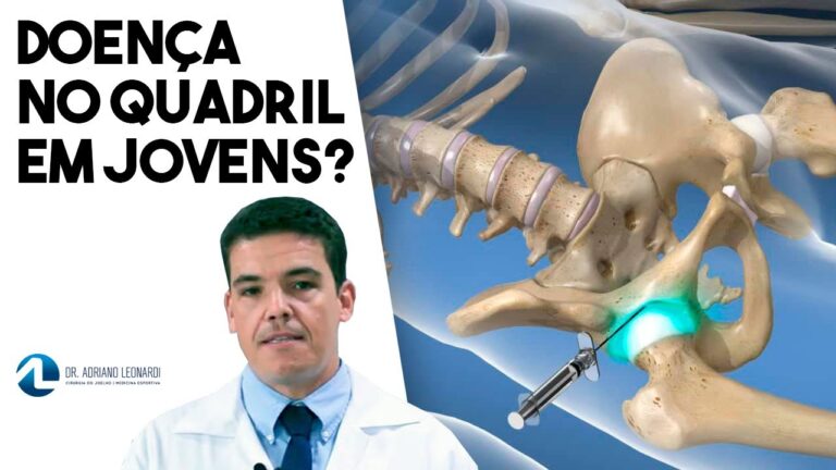 Entendendo a Condropatia de Quadril: Causas e Tratamentos
