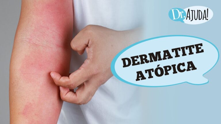Gerenciamento Eficaz da Inflamação Cutânea Grave