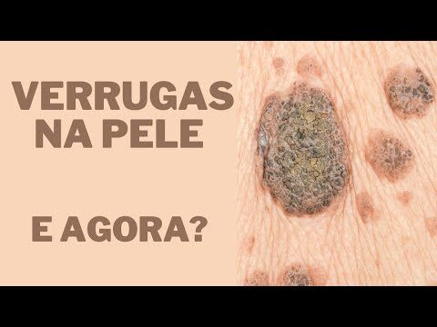Especialistas em Verrugas: Soluções Eficazes para Tratamentos